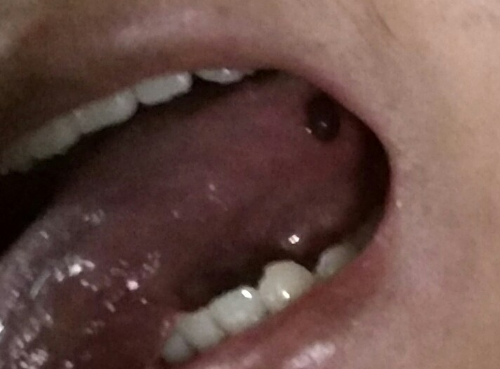 舌头上起个黑血泡图片图片